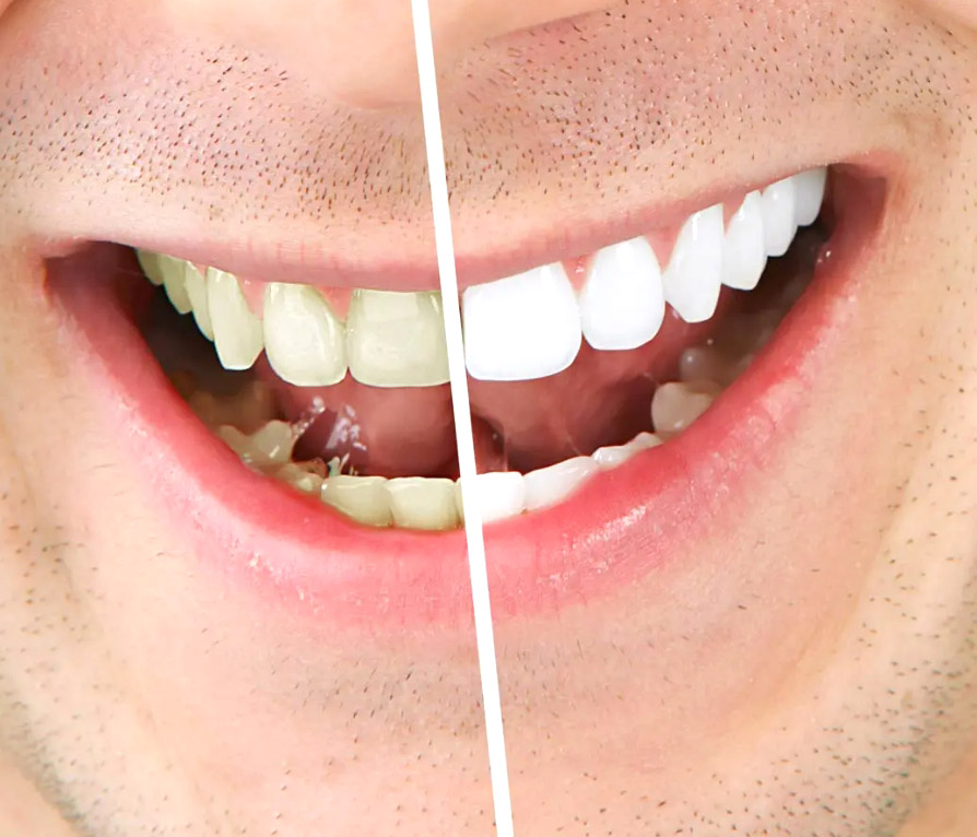 banner-tooth-Whitening-