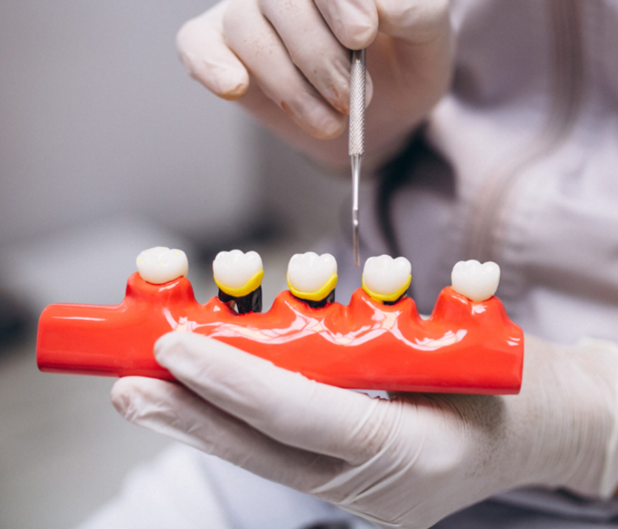 banner-dental-crowns-