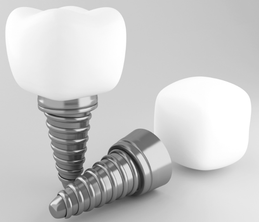 banner-dental-implants